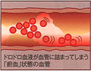 瘀血とは